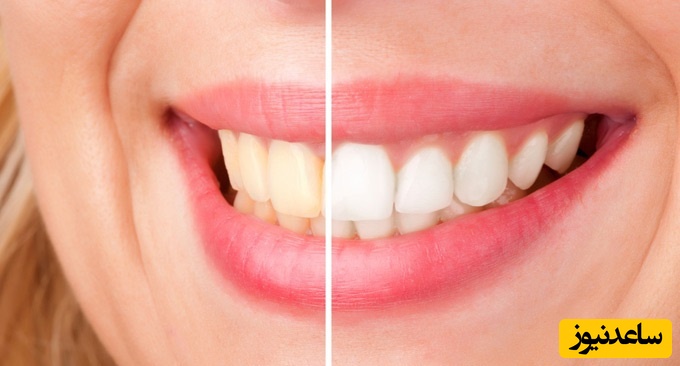 چه خوردنی هایی باعث زرد رنگ شدن دندان های می شوند؟