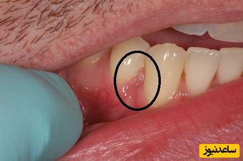 کیست دندانی چند نوع است؟ و راه های درمان آن