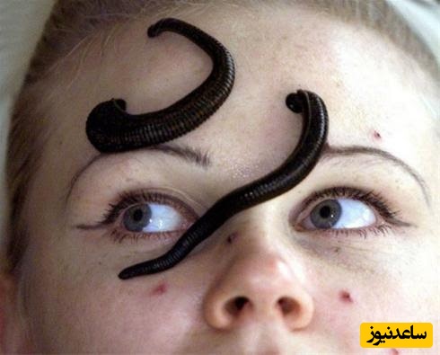 زالو درمانی در درمان بیماری های لثه