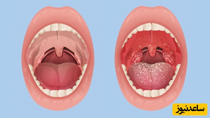 علت درد زبان چیست؟