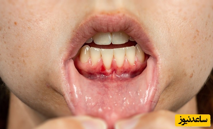  بیماری های لثه 