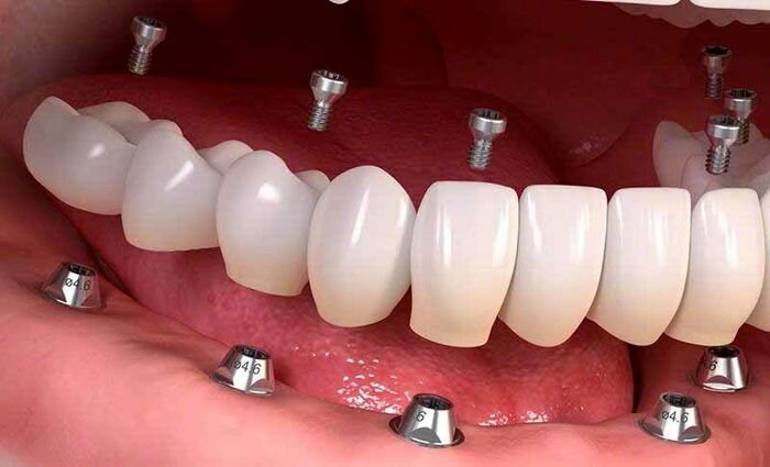 چطور کاندید مناسبی برای ایمپلنت دندان محسوب میشویم؟
