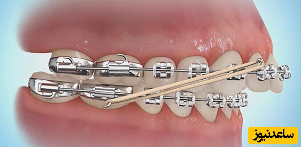 اورژانس ارتودنسی شامل چه مواردی می شود؟