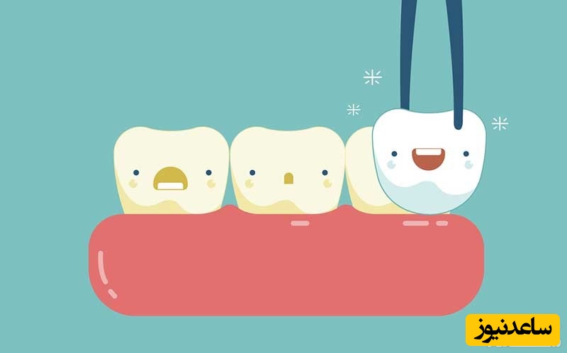 خارج کردن روکش دندان چگونه انجام می‌شود؟