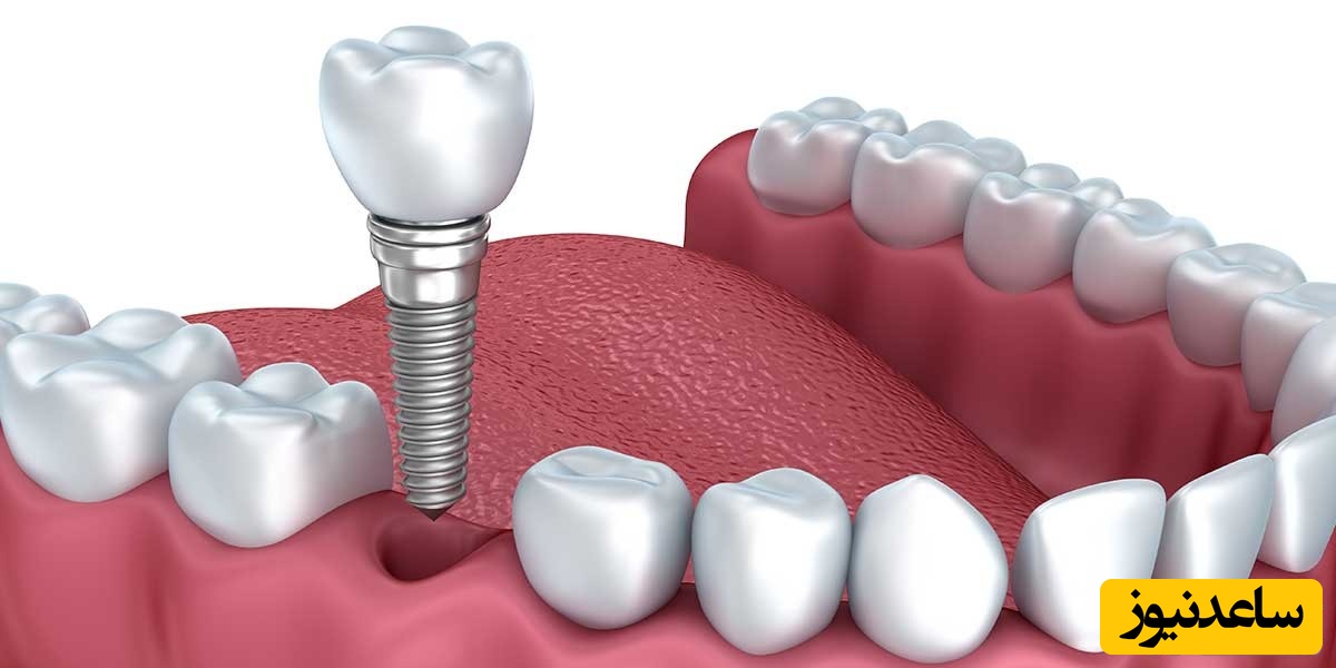 مزایای ایمپلنت دندان چیست؟