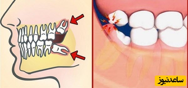 آیا کشیدن یا جراحی دندان عقل ضروری می باشد؟