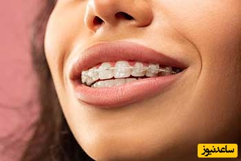 انواع ارتودنسی سرامیکی + نکات مهم