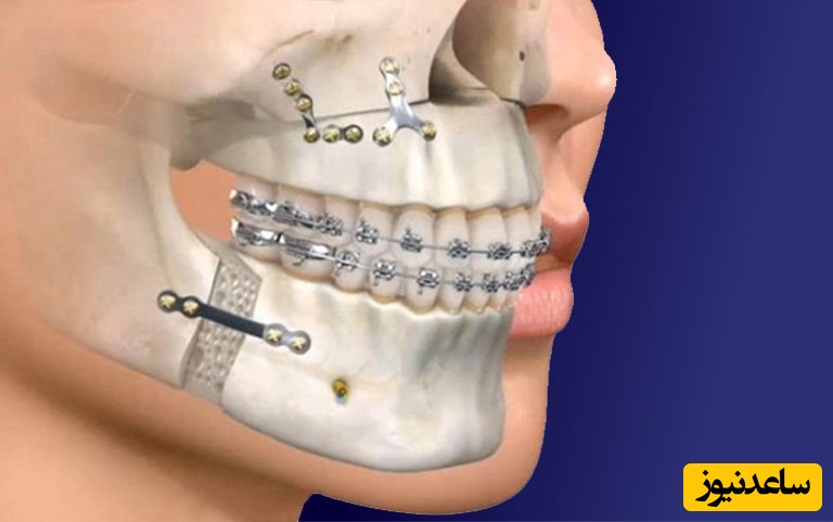 سوالات متداول ارتودنسی جراحی ارتوگناتیک