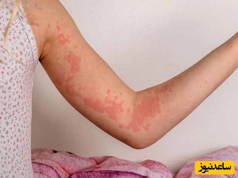 درمان کهیر در طب سنتی؛ راهکارهای گیاهی و طبیعی برای رهایی از خارش