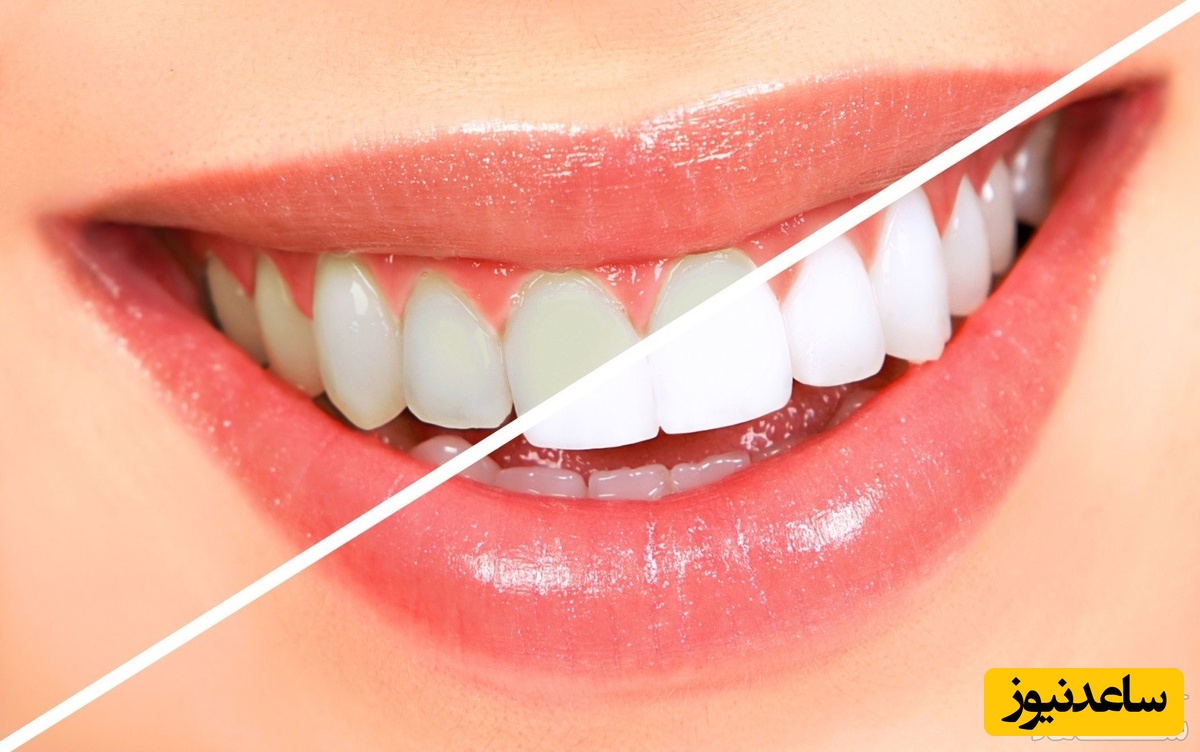 درمان حساسیت بعد از بلیچینگ دندان با چند روش ساده