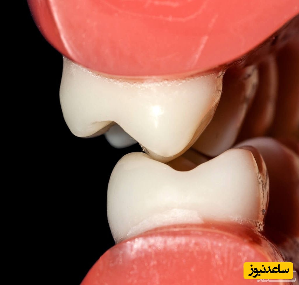 علت سایش دندان بر روی دندان دیگر چه چیزی می تواند باشد؟