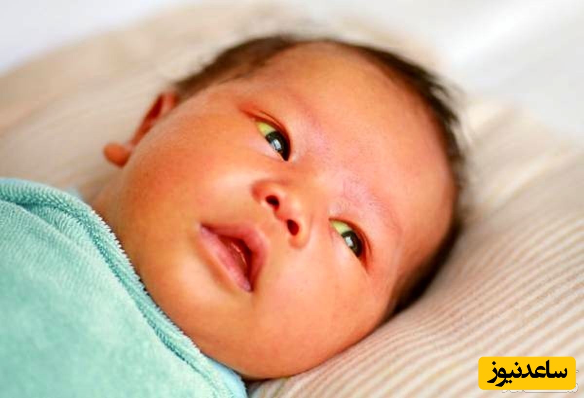 دلایل زرد شدن چشم نوزاد و کودک چیست؟