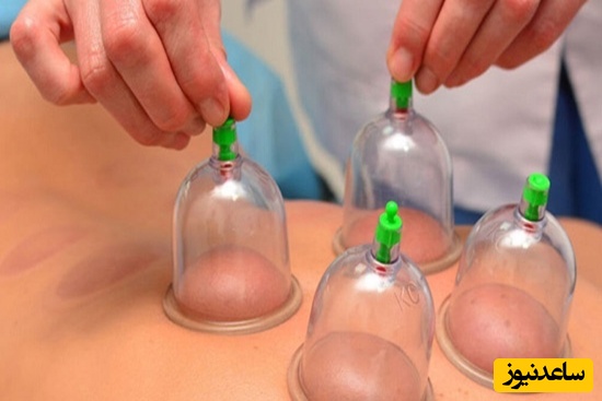 ویژه آقایان متاهل؛ درمان زودانزالی مردان با حجامت