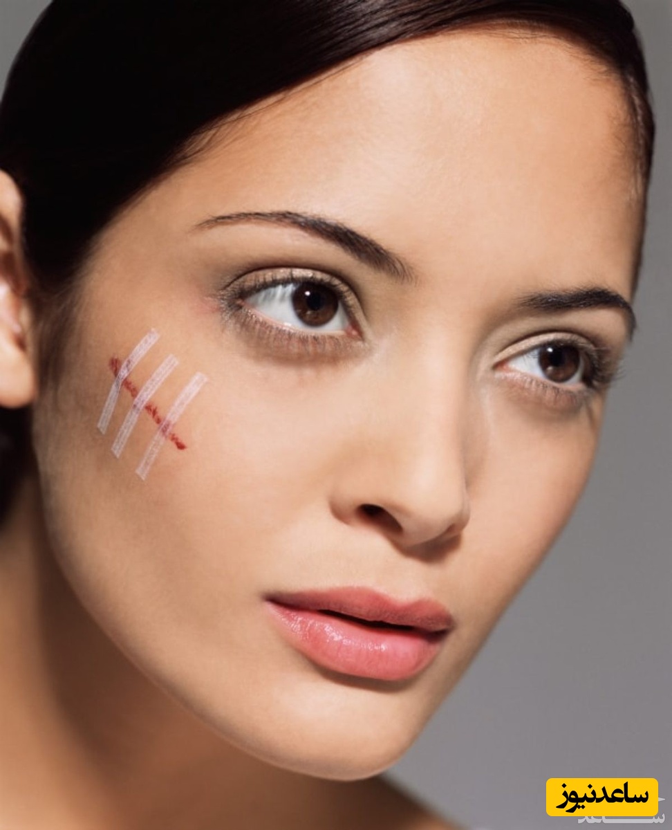چگونه جای زخم یا اسکار را سه سوتِ رفع کنیم؟