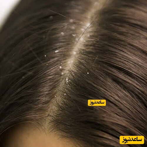 پوستر شوره سر