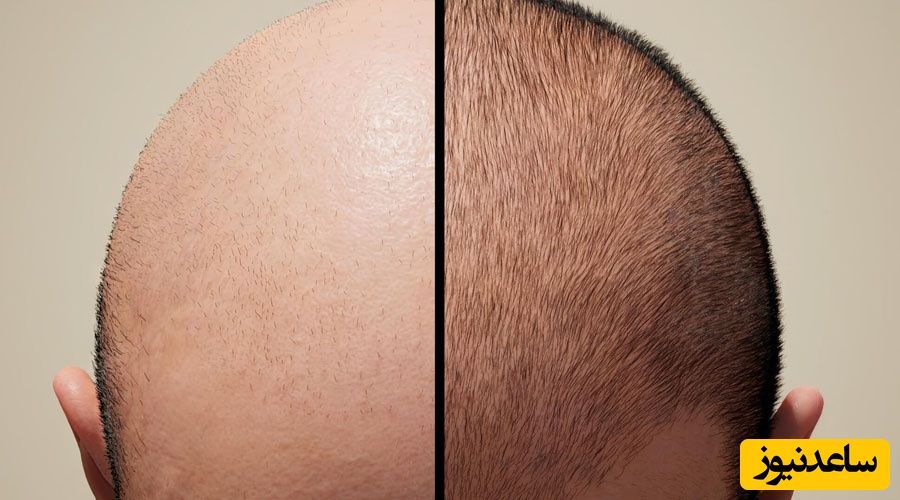 آیا کاشت مو در مردان دائمی است؟