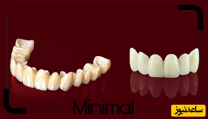 انواع روکش دندان کدام است؟