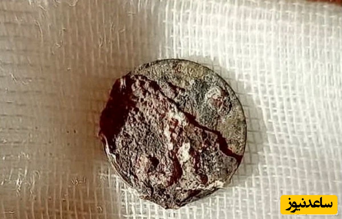 مردی که نیم قرن با سکه در بینی اش زندگی می کرد!