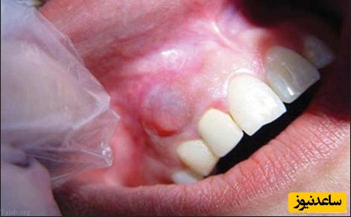 کیست دندان چیست؟