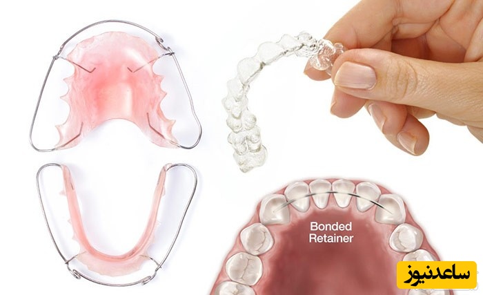 ارتودنسی ثابت و متحرک، کدامیک بهتر است؟