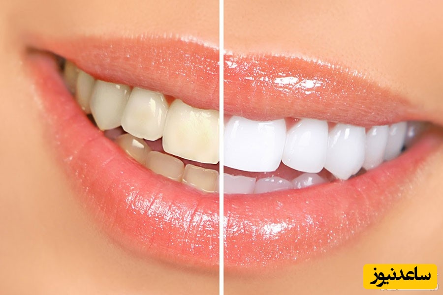 تغییر رنگ دندان چیست و درمان آن