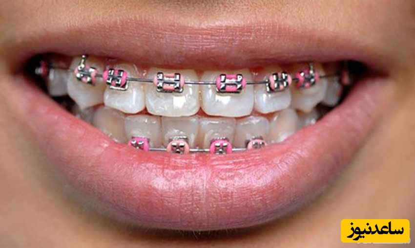 تاخیر در درمان ارتودنسی