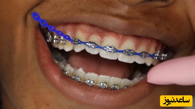 نقش ایمپلنت در ارتودنسی