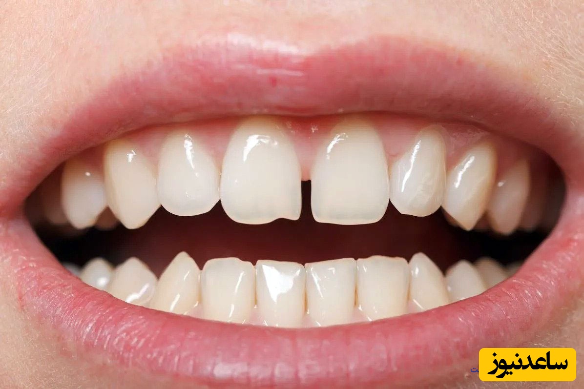 چند روش برای درمان فاصله بین دندان ها