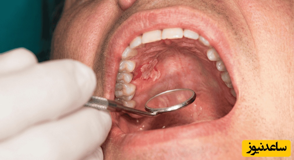 دلیل تورم سقف دهان