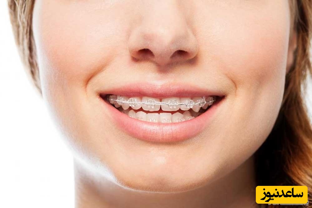 چرا بهتر است جراحی بینی بعد از ارتودنسی باشد؟