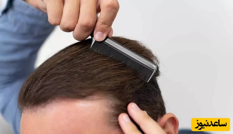 بهترین روش کاشت مو در مردان