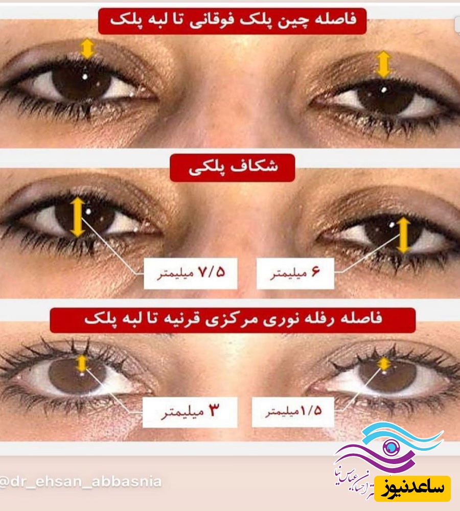 جراحی بلفاروپلاستی