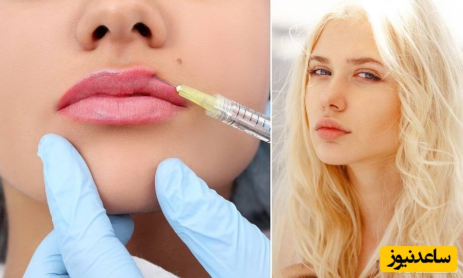 تزریق ژل لب روسی چیست؟