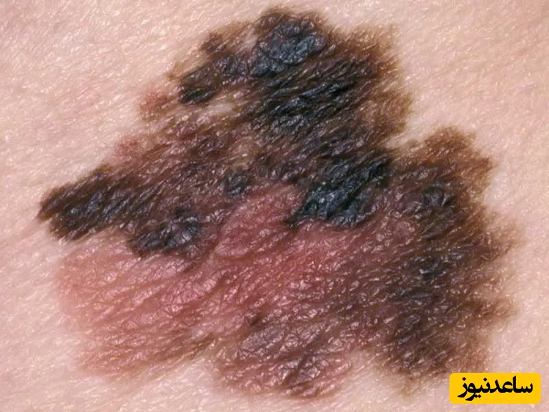 علایم سرطان پوست