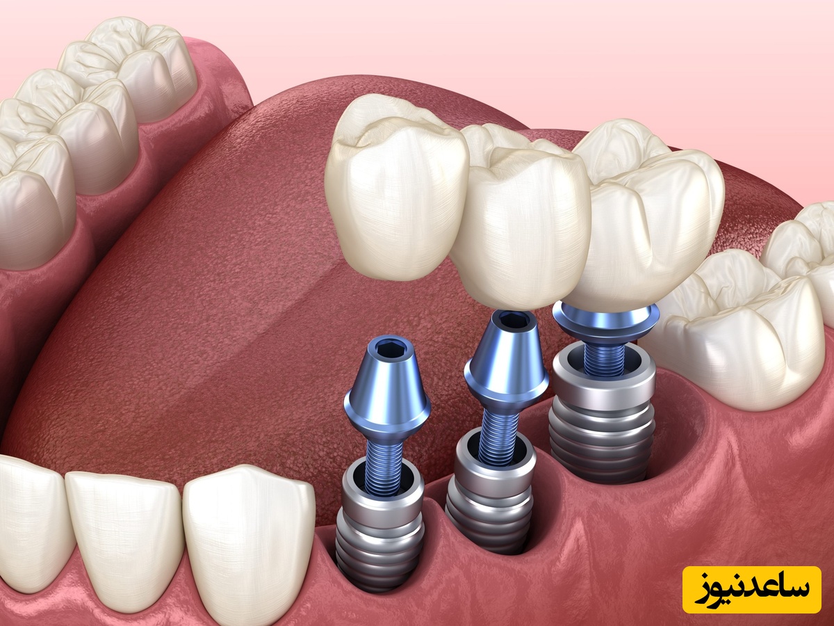 چرا ایمپلنت دندان شکست می‌خورد!؟