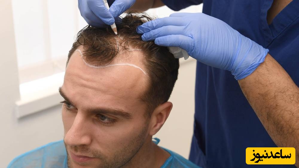 هزینه کاشت مو به روش FIT در پیشرفته‌ترین کلینیک‌های زیبایی تهران 1404