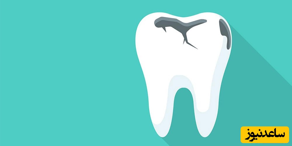 ایا دندانم نیاز به عصب کشی دارد؟!