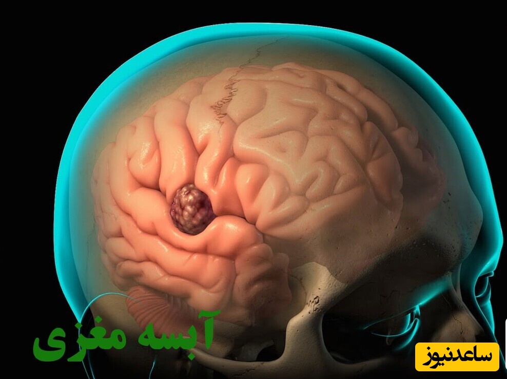 (ویدئو) آیا می دانستید اگر دندانتان عفونت کرده باشد ممکن است منجر به ایجاد توده در مغز شود؟!