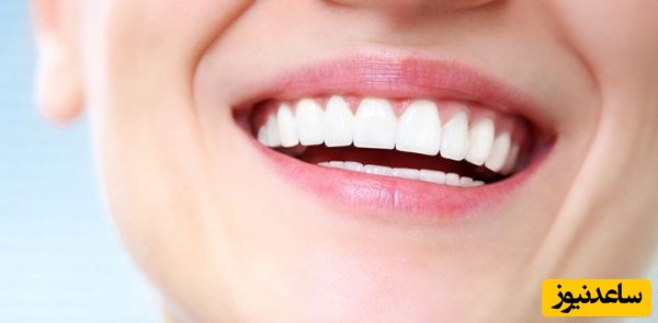 تفاوت لمینت و لومینیرز