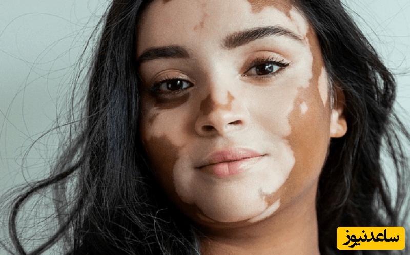 درمان‌های خانگی برای از بین بردن لکه‌های سفید روی پوست
