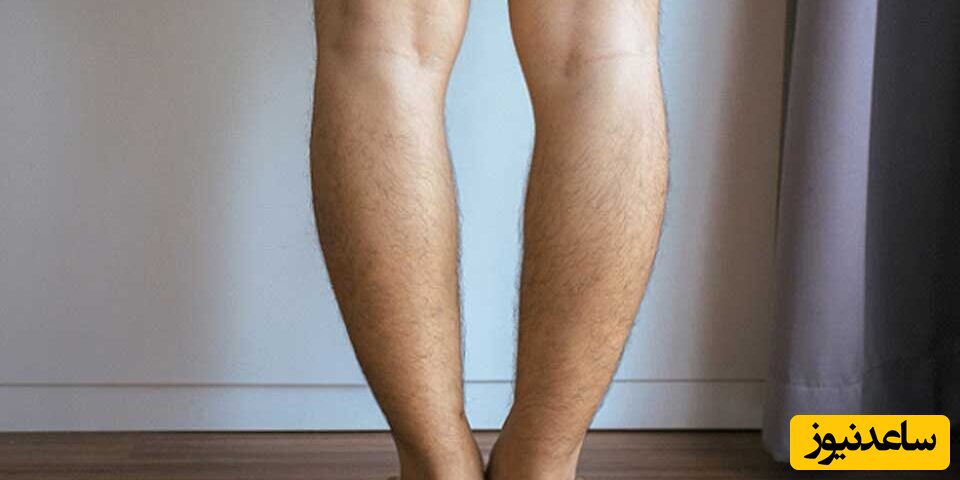 بهترین سن برای درمان پای پرانتزی چند سالگی است؟