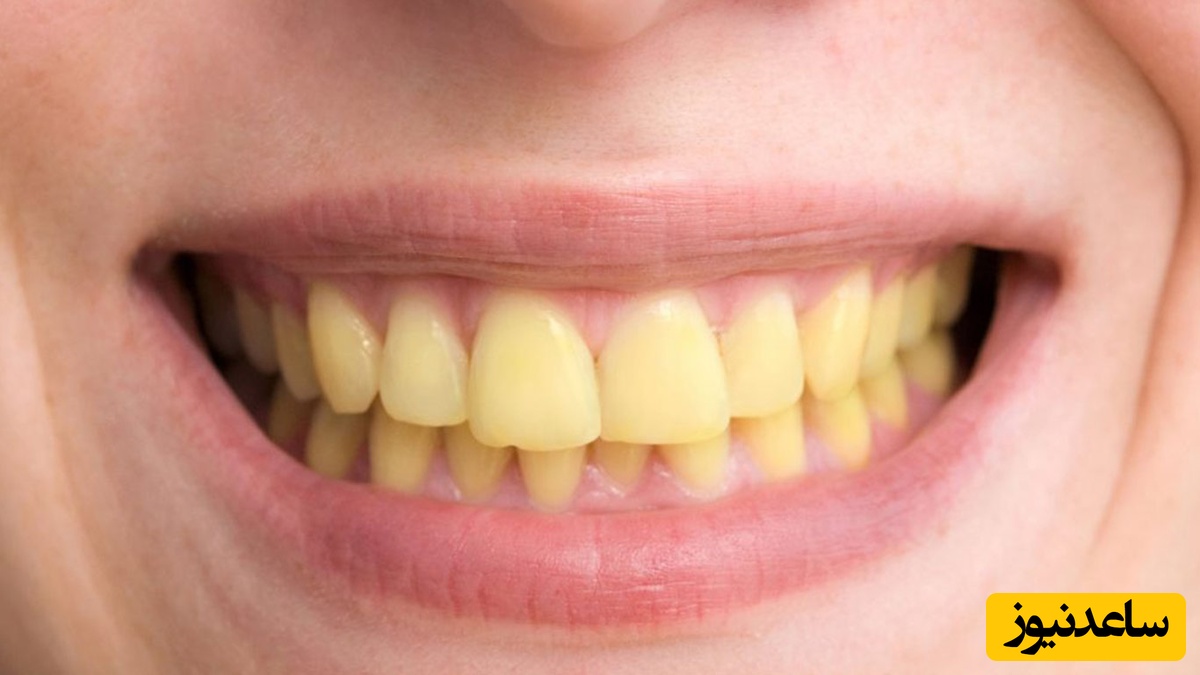 چه عواملی باعث بروز دندان‌های زرد کودک می‌شود؟