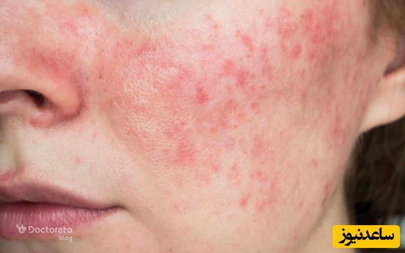 علایم سرطان پوست