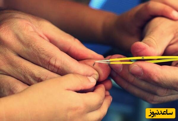 چگونه تیغ یا خار را از پوست به‌راحتی و ایمن بیرون بیاوریم؟