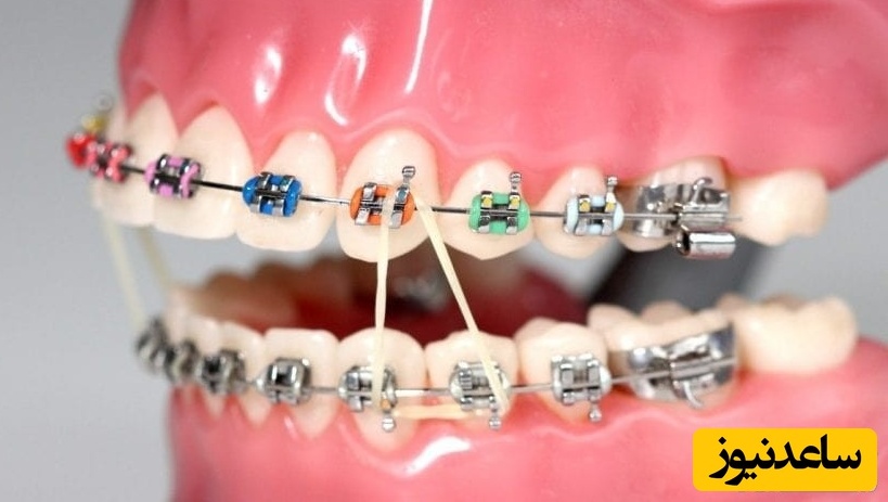 ارتودنسی برای یک دندان امکان پذیر است؟