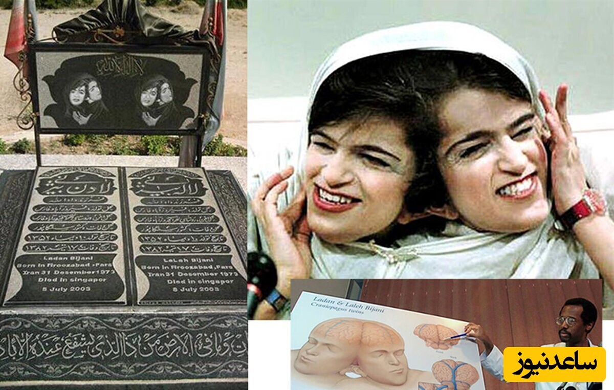 ویدیو؛ مستند لاله و لادن / پشت‌پرده عمل جراحی دوقولوهای به هم چسبیده‌ای که هرگز همدیگر را ندیدند!