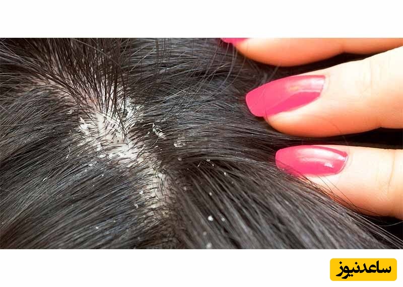 پوسته پوسته شدن سر؛ علت، درمان قطعی شوره و راه‌های پیشگیری این مشکل را کشف کنید