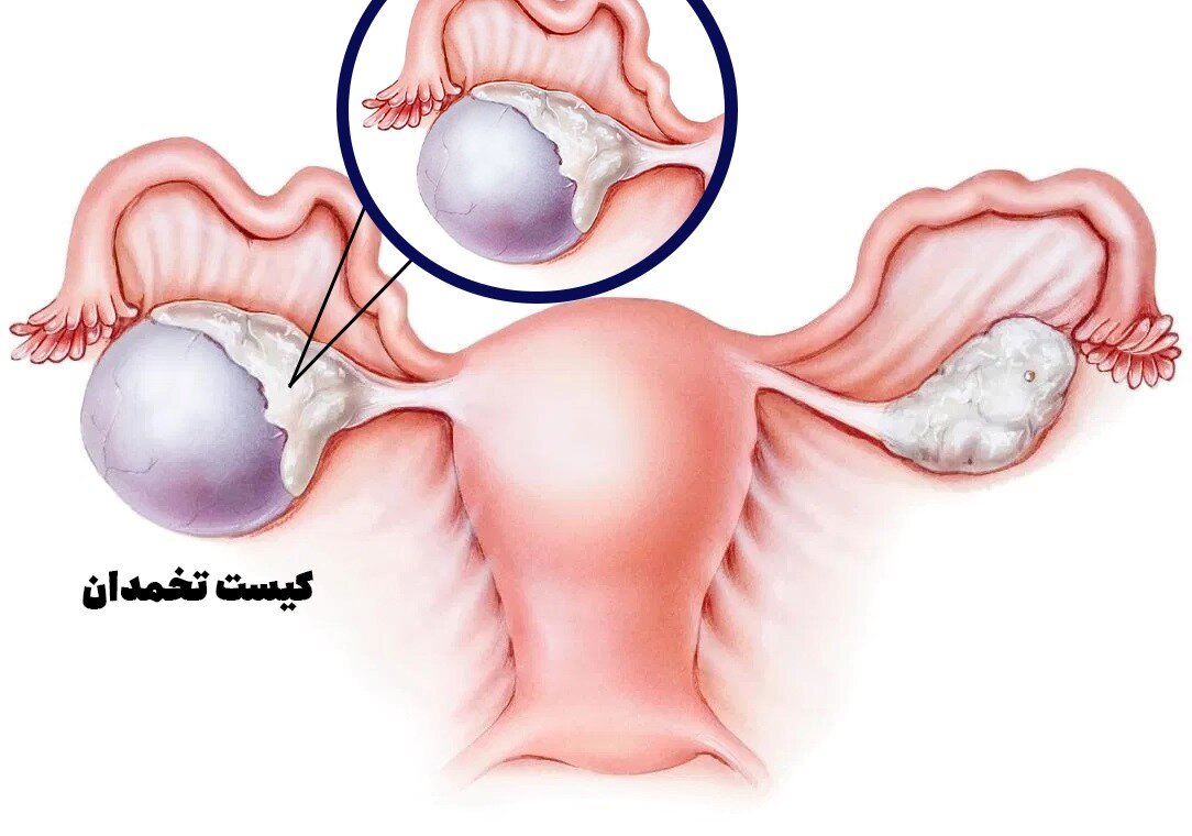 کیست تخمدان
