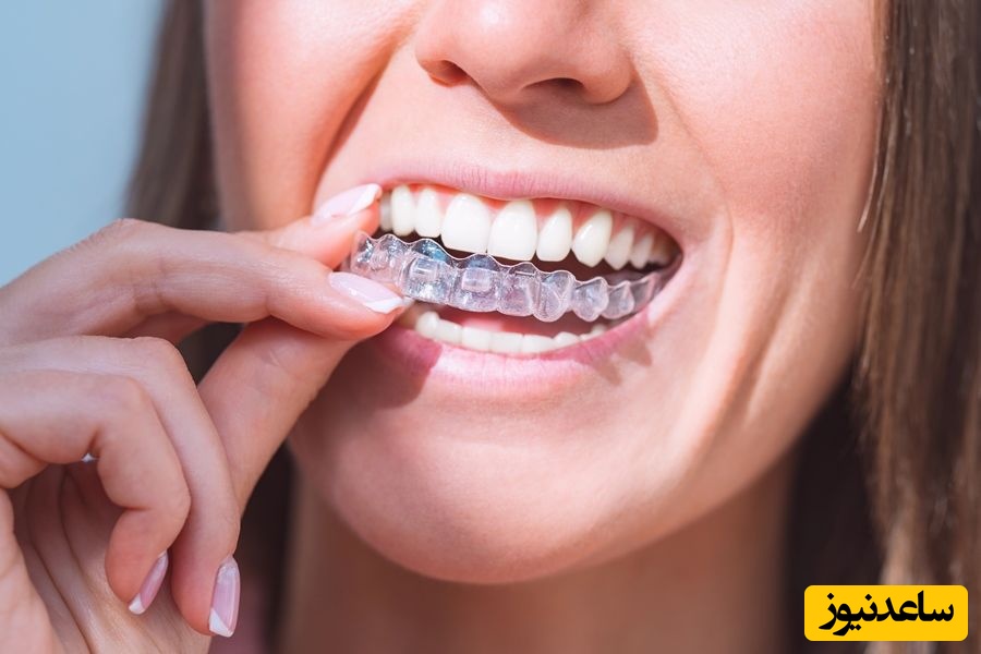 تغذیه در زمان درمان ارتودنسی