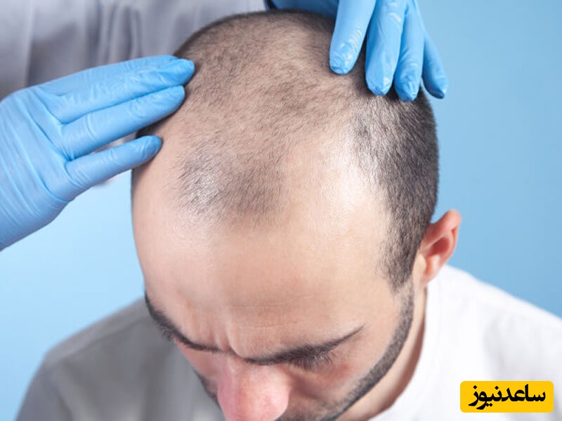 اصول و شرایط برقراری رابطه جنسی بعد از کاشت مو